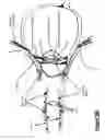 Fig. 12 - Reprogrammable tuneable liquid crystal lens intraocular implant and methods therefor
