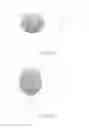 Fig. 10 - METHODS AND INTRAOCULAR LENS FOR COUNTERACTING ASTIGMATISM ABERRATIONS