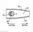 Fig. 01 - Anatomic osteotomy wedge
