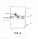 Fig. 04 - Flexible anchoring and fusion devices and methods of using the same