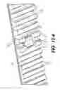 Fig. 17 - Coiling implantable prostheses