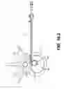 Fig. 34 - Coiling implantable prostheses