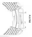 Fig. 41 - Coiling implantable prostheses
