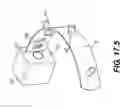 Fig. 42 - Coiling implantable prostheses