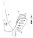 Fig. 43 - Coiling implantable prostheses