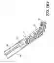 Fig. 51 - Coiling implantable prostheses