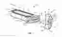 Fig. 02 - Spinal implant system and method