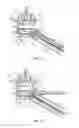 Fig. 08 - Spinal implant system and method