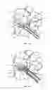 Fig. 10 - Spinal implant system and method