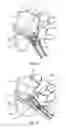 Fig. 11 - Spinal implant system and method