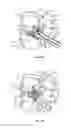 Fig. 13 - Spinal implant system and method
