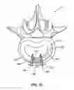 Fig. 16 - Spinal implant system and method