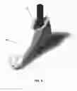 Fig. 09 - Additive manufacturing produced prosthetic foot