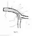 Fig. 08 - Medical stent