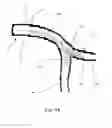 Fig. 12 - Medical stent