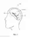 Fig. 02 - VASCULAR IMPLANT FOR TREATING ANEURYSMS