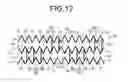 Fig. 10 - Stent