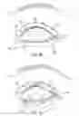 Fig. 13 - Controller for dry eye treatment systems