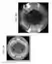 Fig. 10 - Vacuum loss detection during laser eye surgery