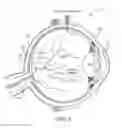Fig. 02 - OCULAR GELS OR HYDROGELS AND MICROINJECTORS