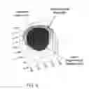 Fig. 15 - Laser eye surgery lens fragmentation