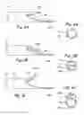 Fig. 03 - Devices useable for treatment of glaucoma and other surgical procedures