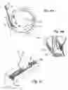 Fig. 06 - Devices useable for treatment of glaucoma and other surgical procedures