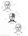 Fig. 04 - TOPICAL TREATMENT OF SHINGLES