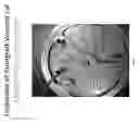 Fig. 11 - NOVEL CHAMBER FOR THE COLLECTION OF LIPOASPIRATE