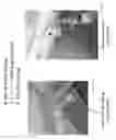 Fig. 19 - NOVEL CHAMBER FOR THE COLLECTION OF LIPOASPIRATE