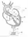 Fig. 01 - Guidable intravascular blood pump and related methods