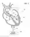 Fig. 02 - Guidable intravascular blood pump and related methods