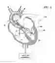 Fig. 07 - Guidable intravascular blood pump and related methods
