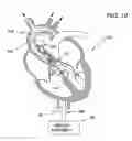Fig. 10 - Guidable intravascular blood pump and related methods