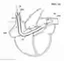 Fig. 19 - Guidable intravascular blood pump and related methods