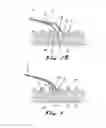 Fig. 04 - DRUG DELIVERY DEVICE