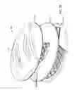 Fig. 40 - RAPID CLOSING SURGICAL CLOSURE DEVICE