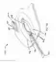 Fig. 75 - RAPID CLOSING SURGICAL CLOSURE DEVICE