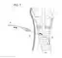 Fig. 06 - TUBE TIP BEVEL TO AID WIRE GUIDE INSERTION
