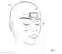 Fig. 02 - FOREHEAD-WEARABLE LIGHT STIMULATOR HAVING ONE OR MORE LIGHT PIPES