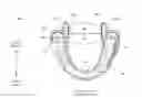 Fig. 01 - Method and apparatus for treating sleep apnea