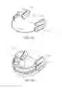 Fig. 14 - Method and apparatus for treating sleep apnea