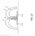Fig. 46 - Methods and apparatuses for remodeling tissue of or adjacent to a body passage