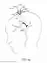 Fig. 06 - Ischemic Stroke Therapy