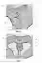 Fig. 05 - Indexable milling insert having side supporting valley, and a milling tool