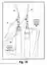 Fig. 10 - Method and apparatus for supercooling of metal/alloy melts and for the formation of amorphous metals therefrom