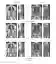 Fig. 05 - Cortical bone segmentation from MR Dixon data