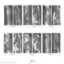 Fig. 06 - Cortical bone segmentation from MR Dixon data