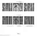 Fig. 07 - Cortical bone segmentation from MR Dixon data