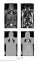 Fig. 08 - Cortical bone segmentation from MR Dixon data